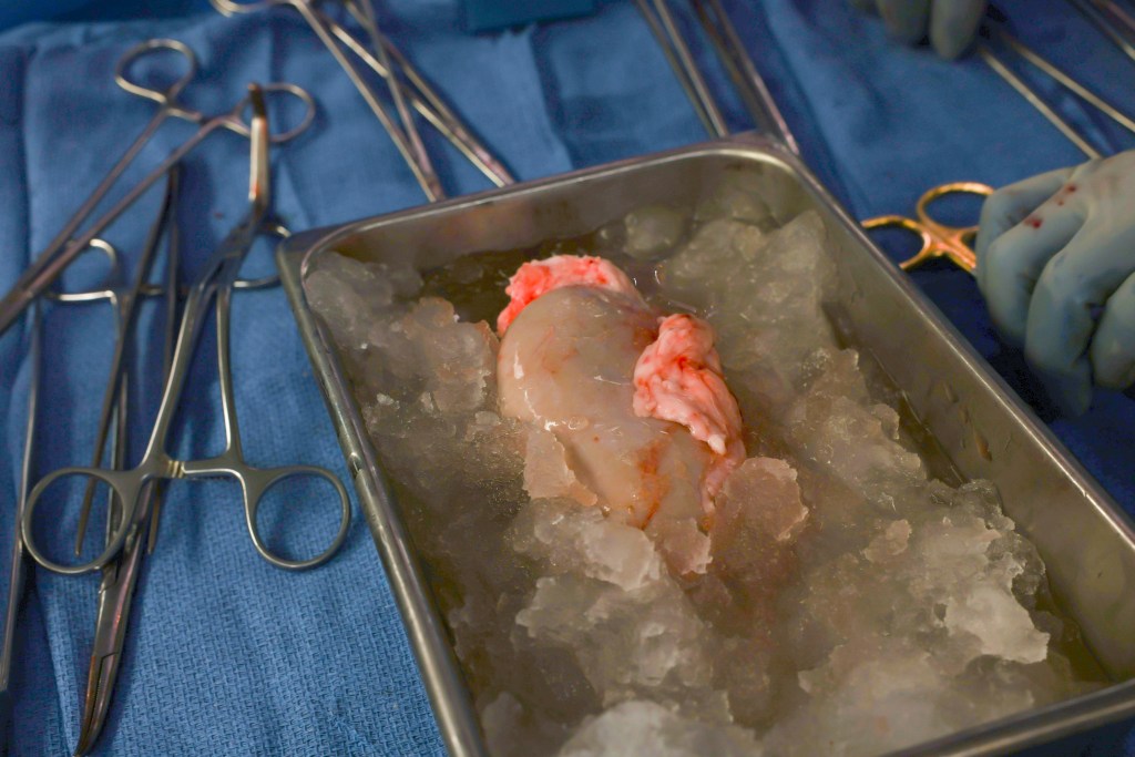 The pig kidney sitting on ice ahead of the transplant.