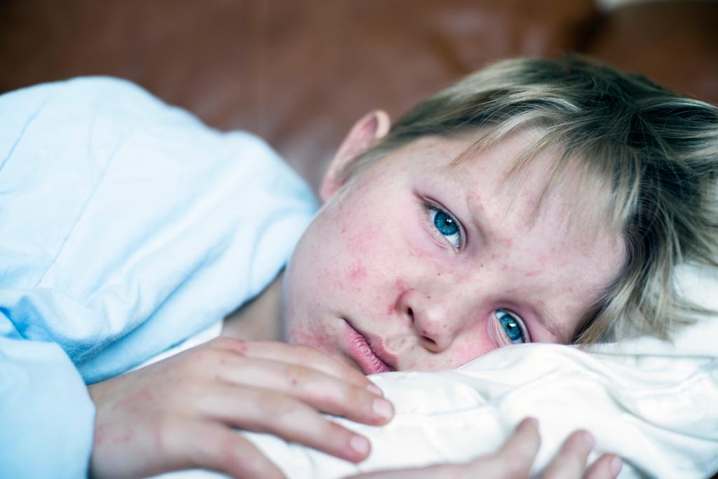 Very sick 5 year old little boy fighting measles infection, boy is laying in bed under the blanket with a agonizing expression, boy is covered with rash caused by virus.