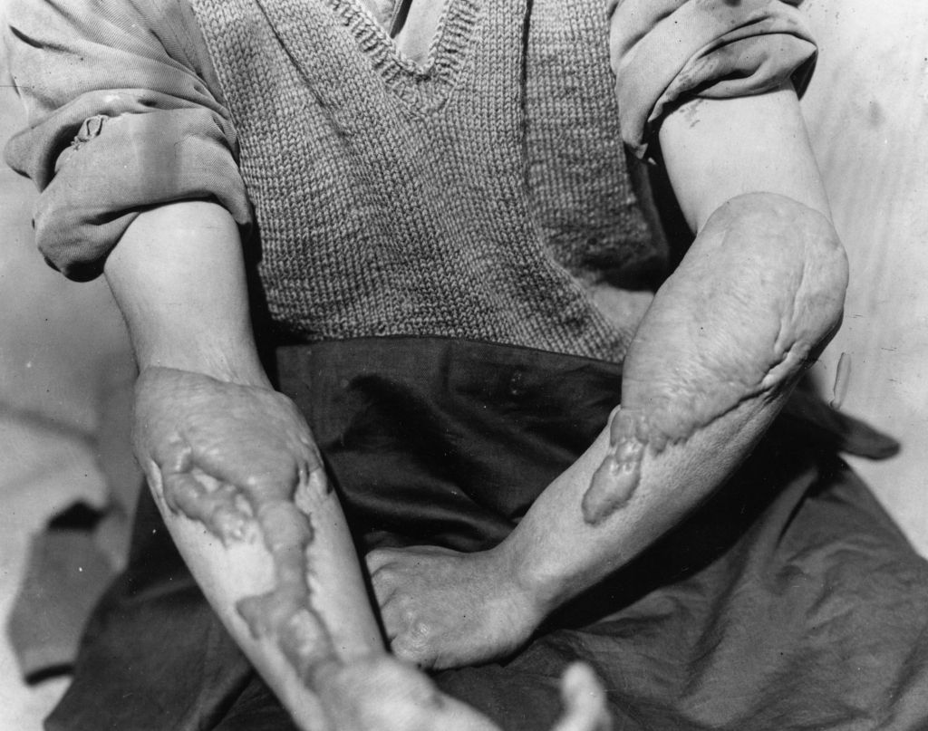 Horrific burn victims from the nuclear attacks on Japan in 1945. 