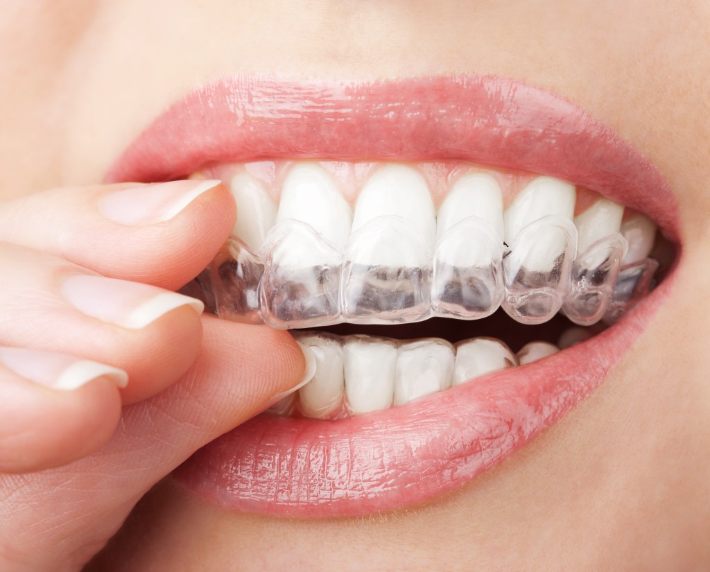 Experts say whitening your teeth at home with over the counter products can be damaging to teeth. 