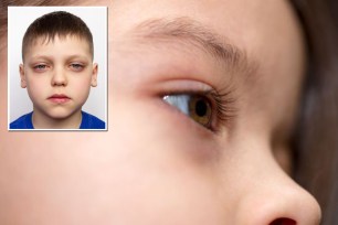 Close up of a child's face displaying dark circles under the eyes