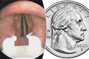 Another day, another unlikely item ending up in an unusual orifice. This time, a California teen had to be hospitalized after swallowing a coin, which wound up getting stuck sideways inside his air passage like a slot machine.