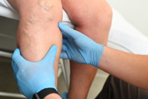 Closeup of person holding a leg with varicose veins