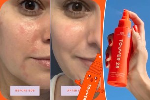 Hypochlorous Acid Sprays Are the Latest Buzzy Acne Treatment