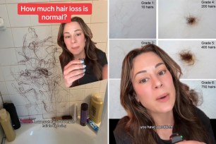 Board-certified dermatologist Lindsey Zubritsky is revealing when you should be concerned about hair loss — basically, if you're shedding 400 or more hairs a day.