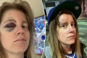 This Blue Jays fan took a nasty bruise to the eye. 