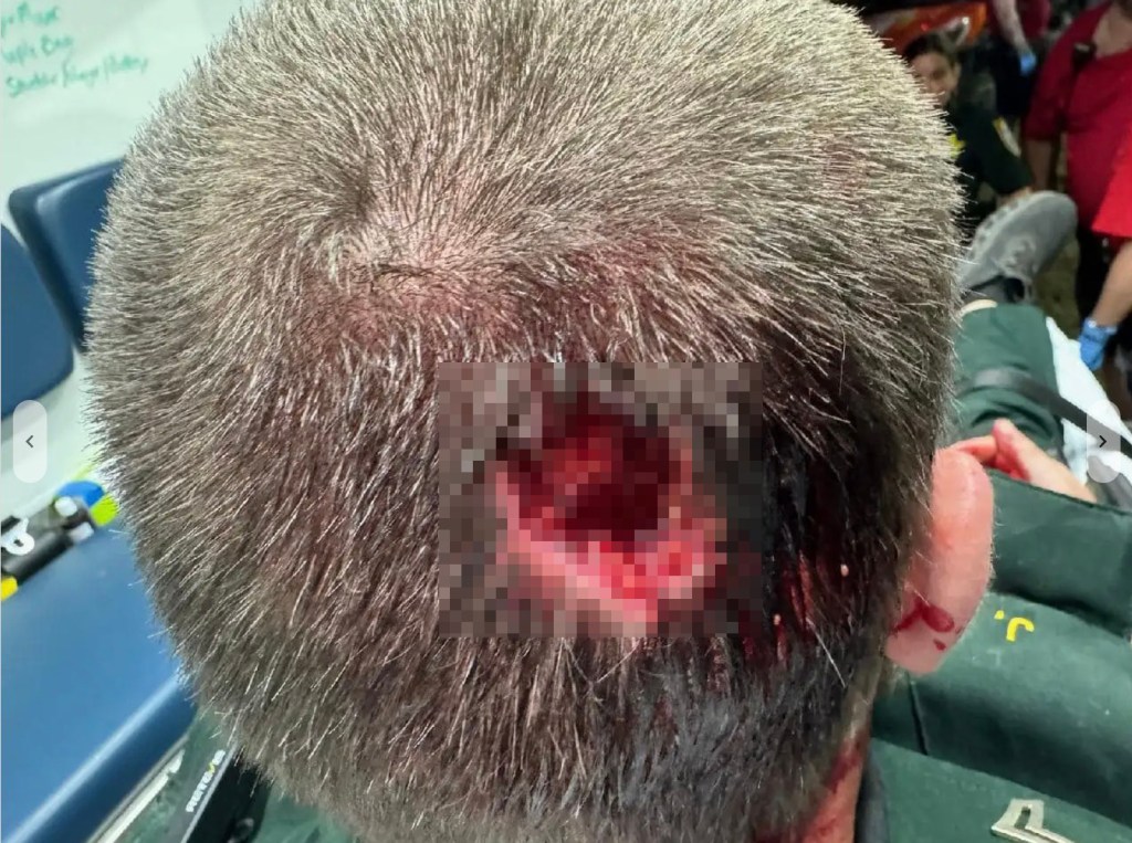 Bit wound on deputy sheriff's head. 
