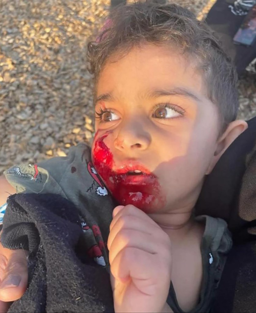 The attack left the three-year-old boy needing surgery after the dog tore skin from his face and ripped open his mouth.
