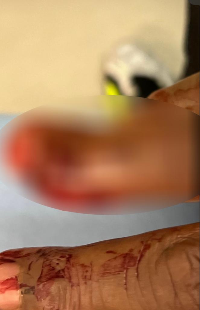 Paul Pierce shows his injured finger on social media. 