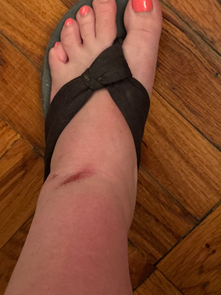 Swollen foot showing scrape on ankle.