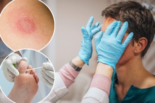 Health experts are warning of new and highly contagious fungal strains after an NYC man in his 30s developed a sexually transmitted form of ringworm — the first reported case in the US.