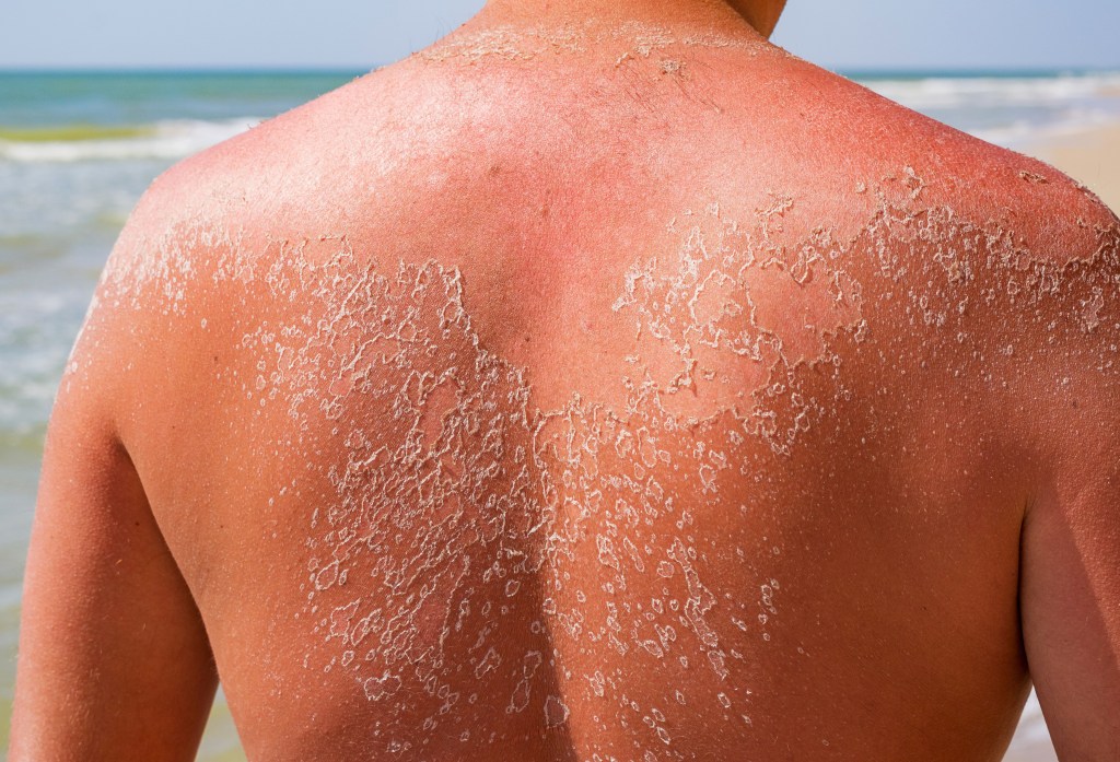 One-third of American adults will experience at least one sunburn this year, statistics show. More than 33,000 of these sunburns require emergency room visits.