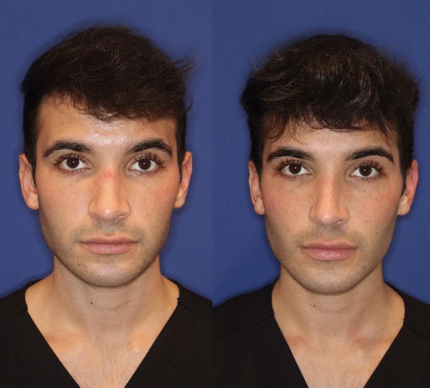 A collage of a man before and after buccal fat removal, chin fat removal, and jawline augmentation procedures