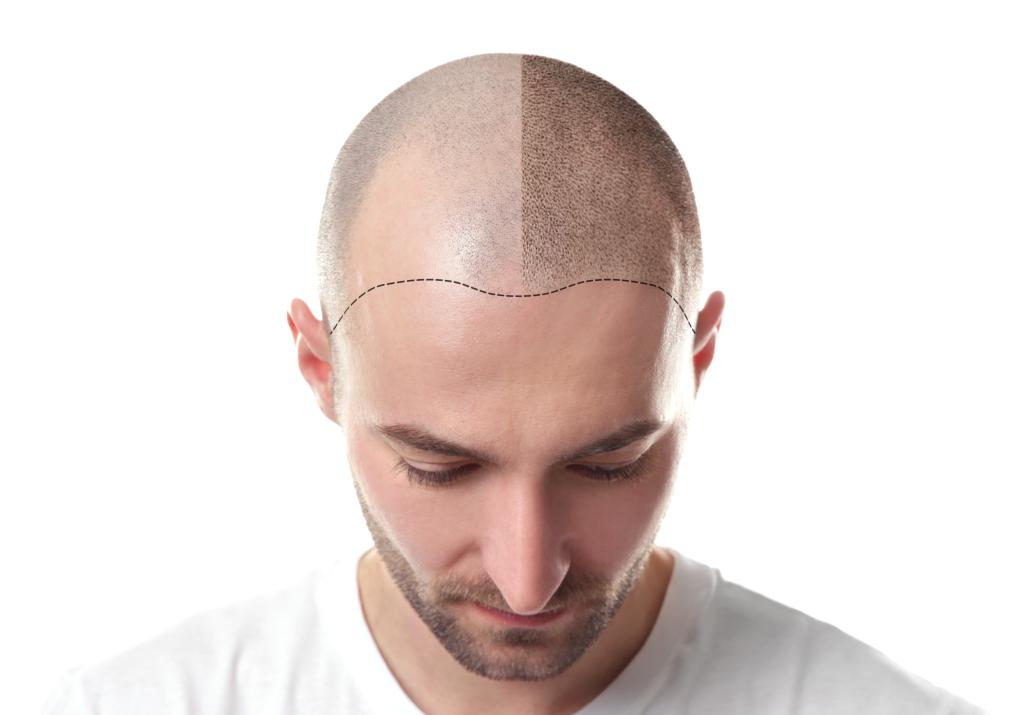 Hair loss concept. Head of man on white background, closeup