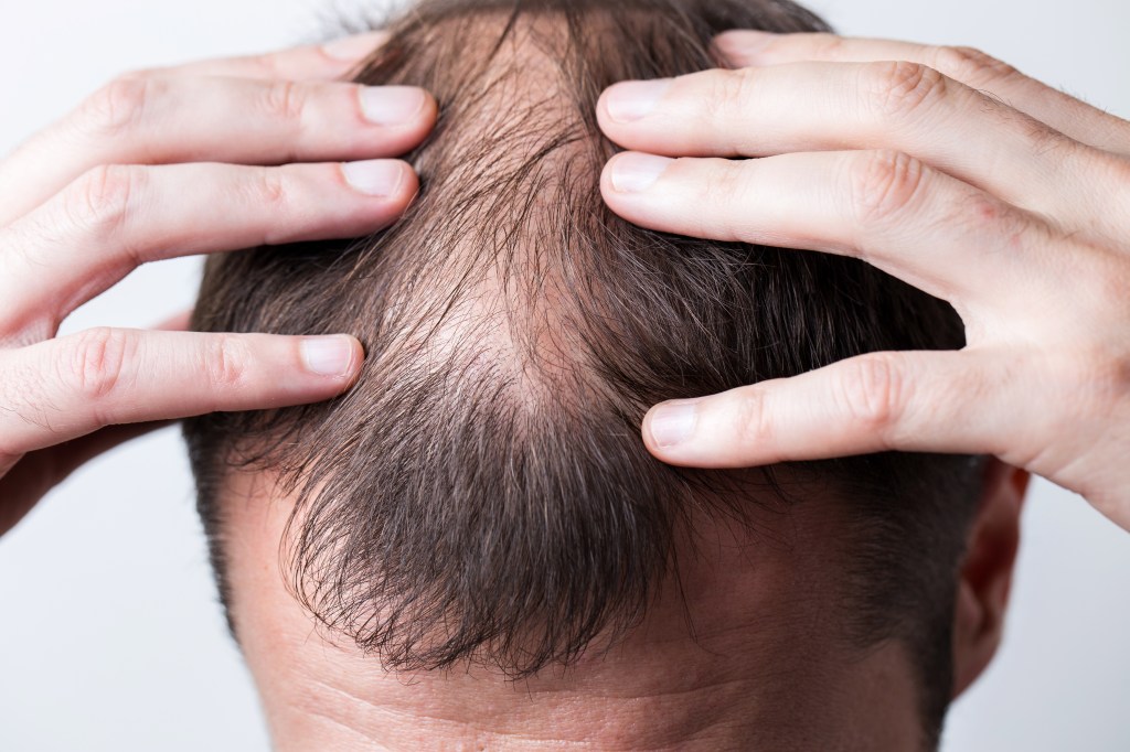 Close-up balding head of a young man on a white isolated background.