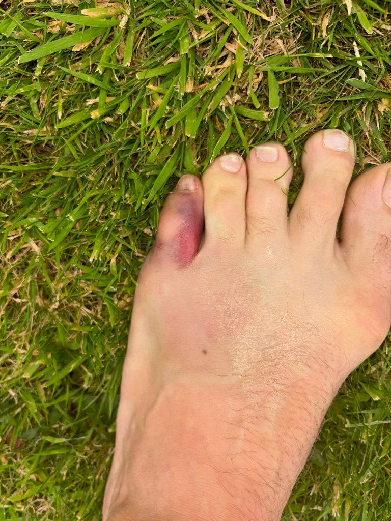 Conor McGregor reveals a broken left pinkie toe is the injury.
