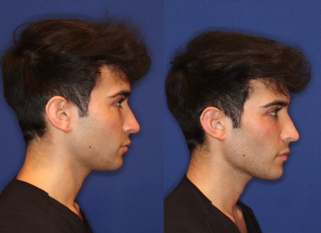 Side view of 23-year-old Ewis Friedenthal, looking focused, after undergoing facial cosmetic procedures for a sharper look.