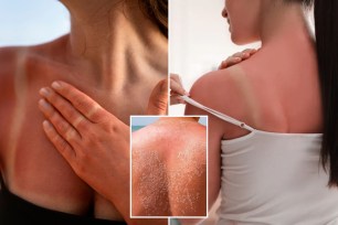 Health experts are sharing the differences between sunburn and sun poisoning — both result from spending too much time in the sun with inadequate protection or no protection at all.