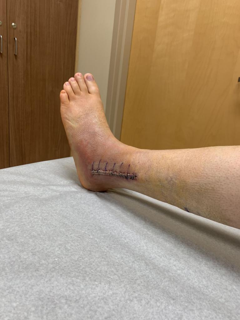 Mary Greenwell, 27, from Boston, Kentucky, after breaking her ankle on her October 2019 wedding day. 