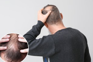 Senior man with hair loss problem on light background