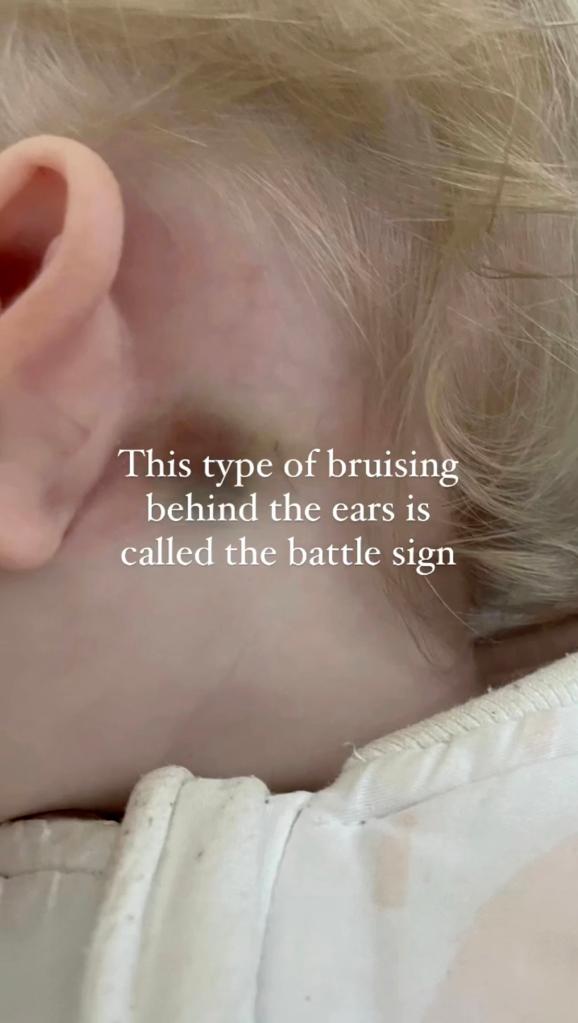 A bruise behind the ear could be a sign of a skull fracture. 