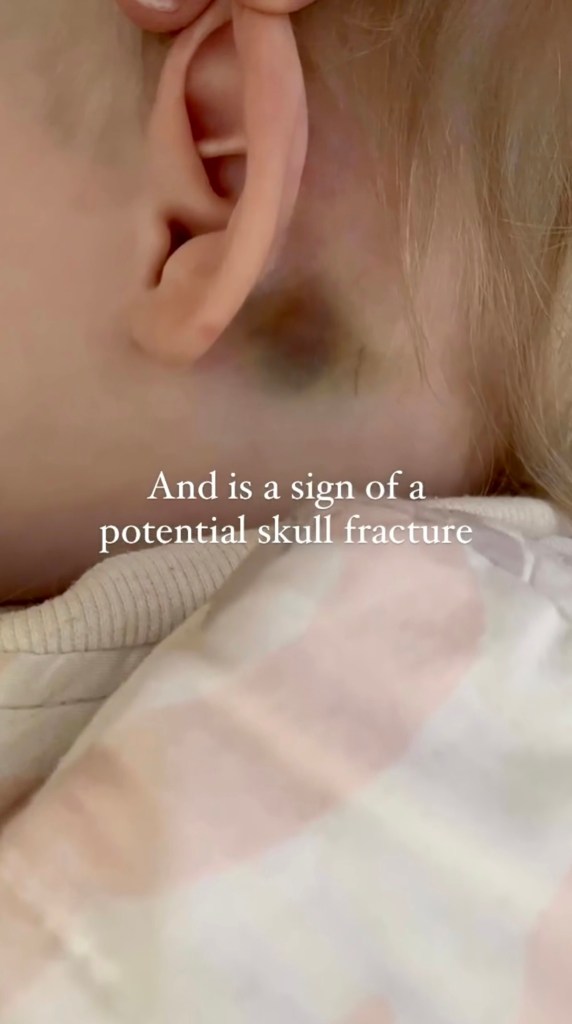 Tiny Hearts Education warns of a bruise behind a Childs ear being dangerous