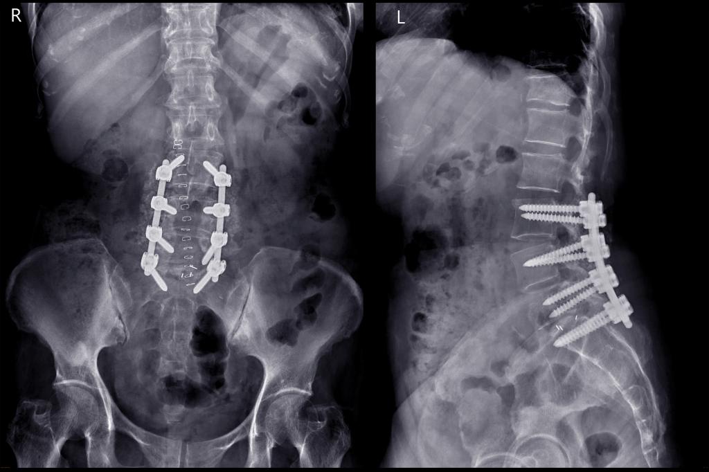 Lesly Ortiz had fusion surgeries on her neck and back (like the one pictured), leaving her in unbearable pain.