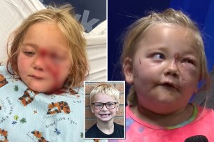 girl after being attacked by dog and picture of brother