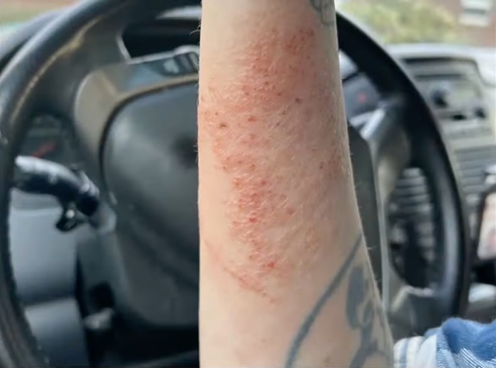 Rogue's arm can be seen covered in a red rash and tiny bite marks