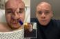 Man has nose ripped off by dog, uses his own ribs to replace it