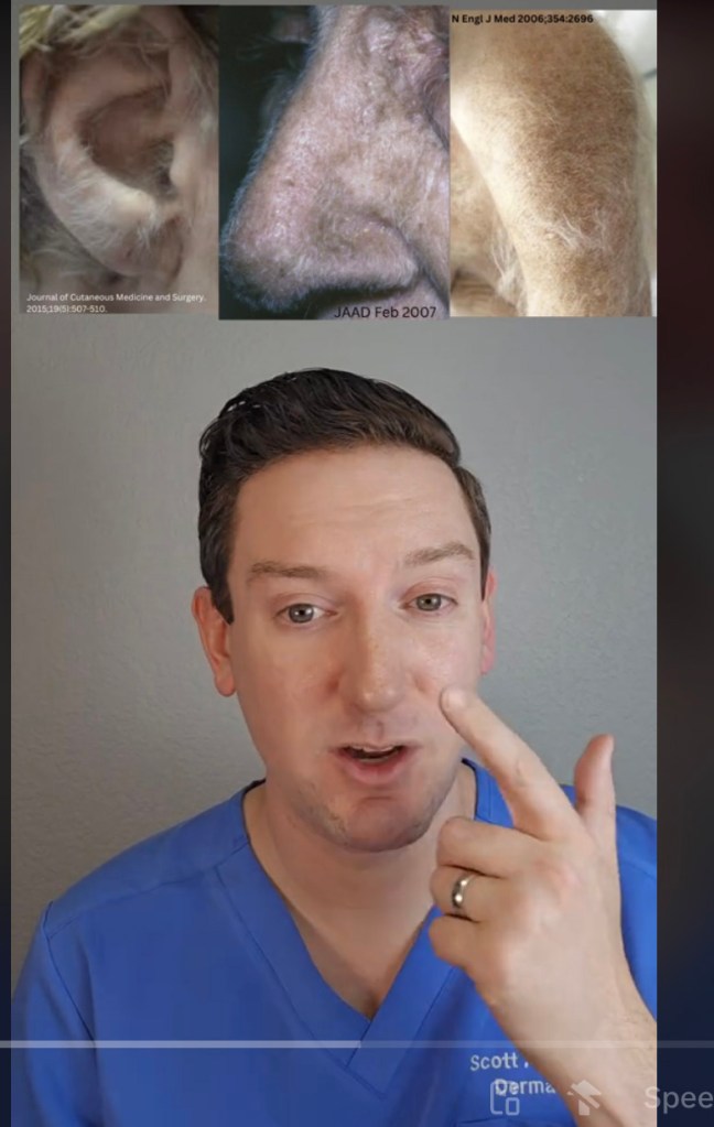 Rapid growth of white, fine hair in places that are normally hairless may mean you have acquired hypertrichosis lanuginosa, Dr. Scott Walter warns in a new TikTok.