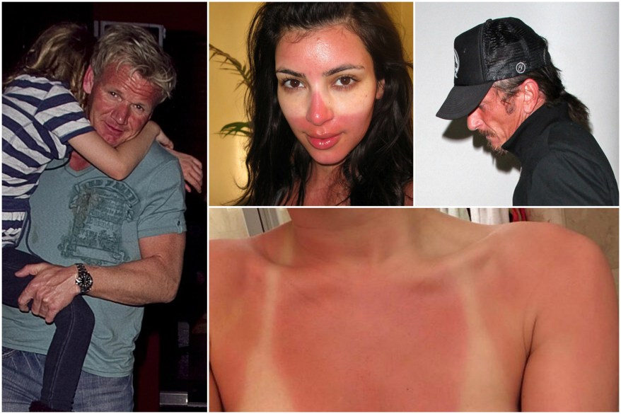 Seeing red: 22 celebrity sunscreen fails