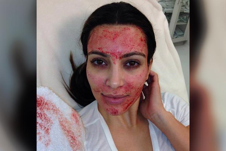 Kim Kardashian during a vampire facial