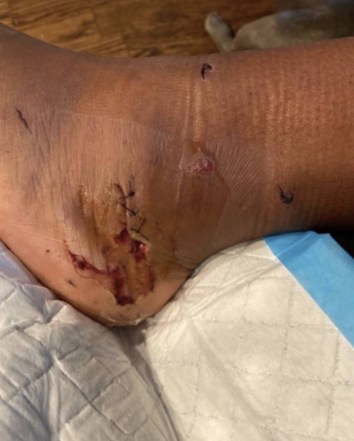 Megan Thee Stallion shared this photo of her injured foot on Instagram.