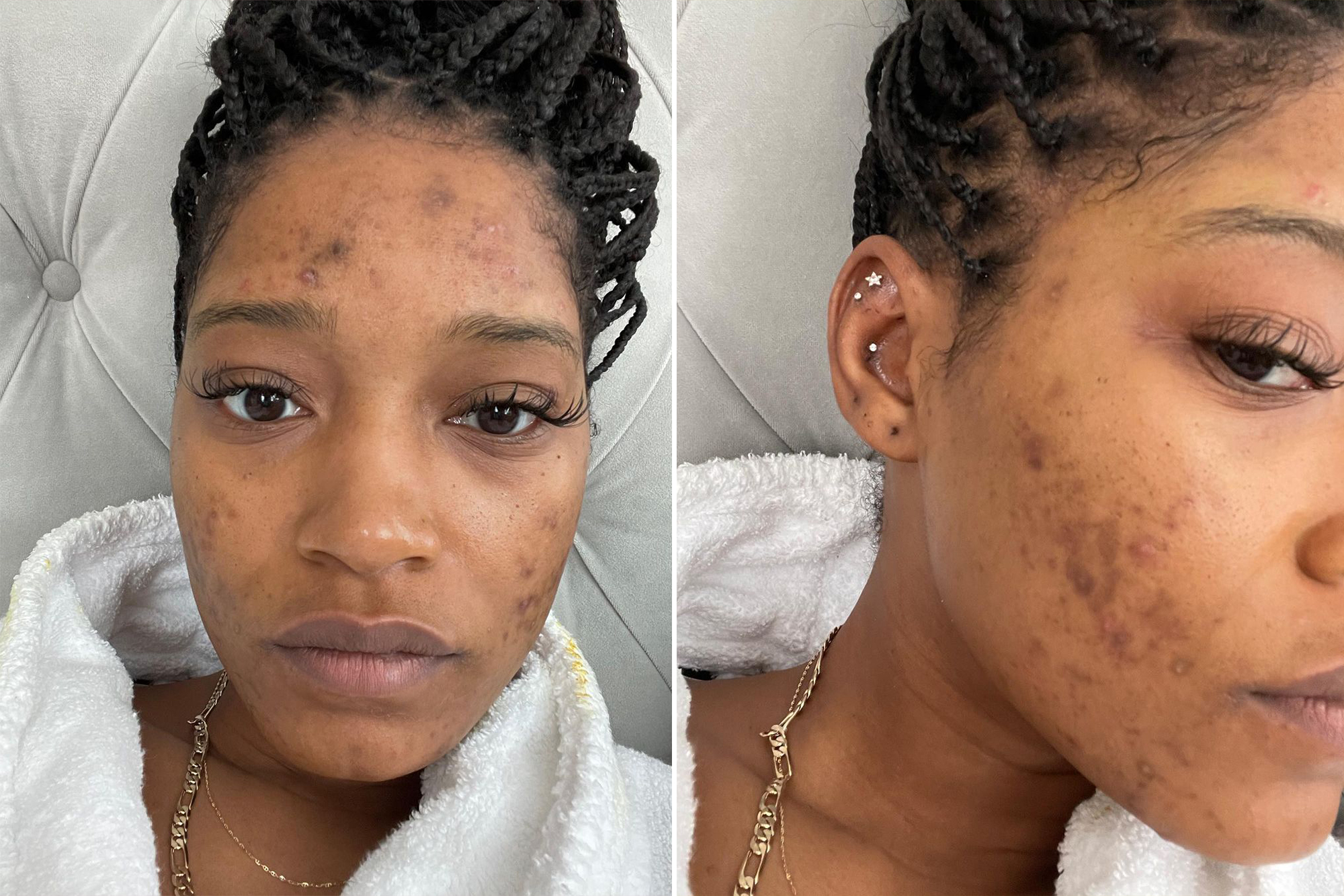 Keke Palmer says her acne is the result of polycystic ovarian syndrome.