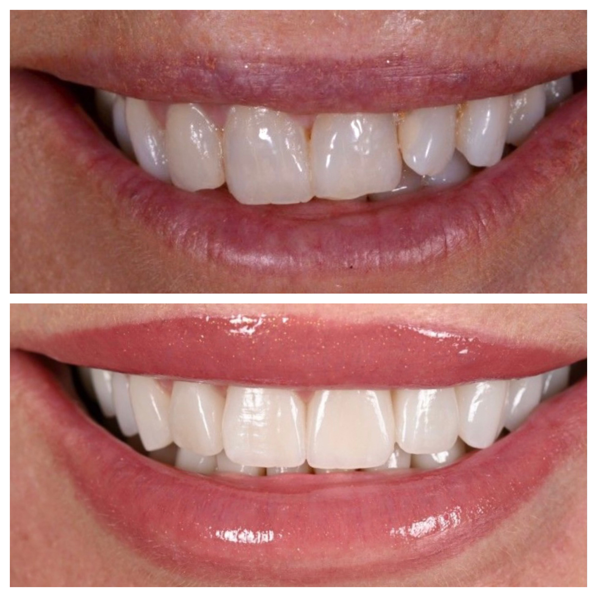 Ramona Singer's teeth up close before and after porcelain veneers.