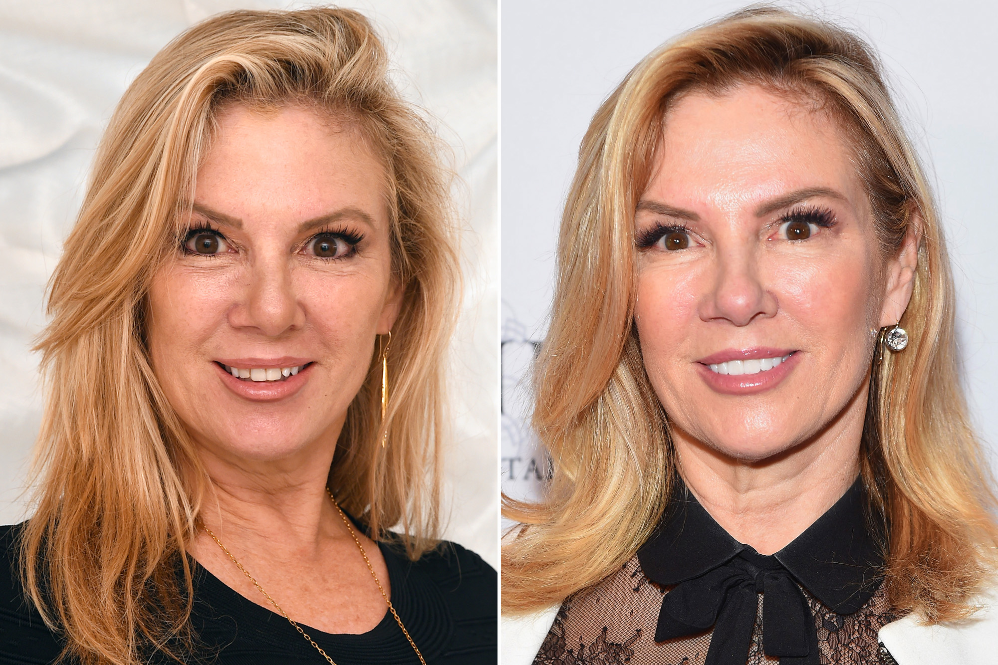 "RHONY" star Ramona Singer before and after new veneers.