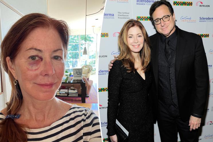 Dana Delany with black eye split with Delany and Bob Saget.