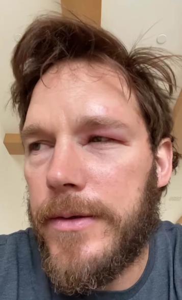 Chris Pratt with a swollen eye