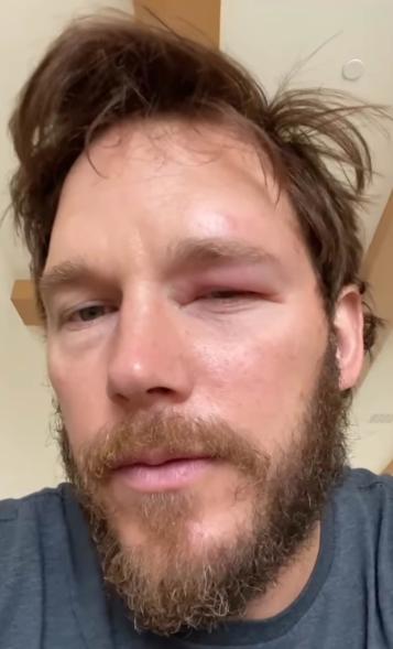 Chris Pratt with a swollen eye