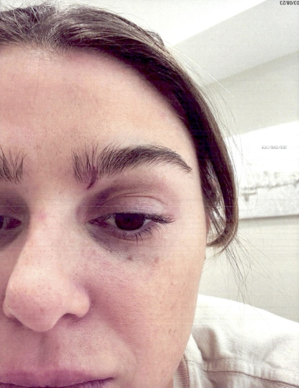 Raquel Leviss' bruised eye.