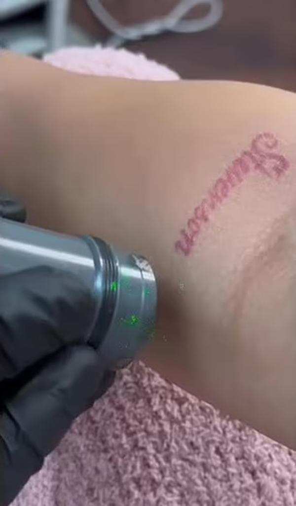 Blac Chyna tattoo removal