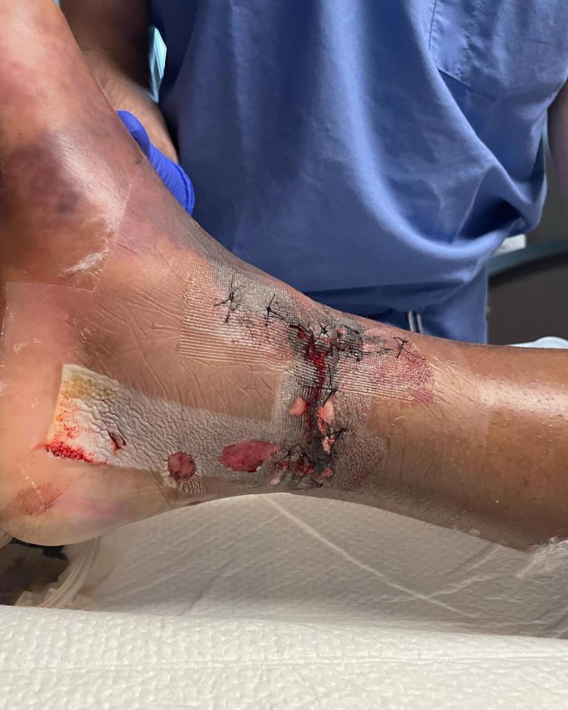 A close-up of Nelson Thomas' stitched-up, swollen ankle.