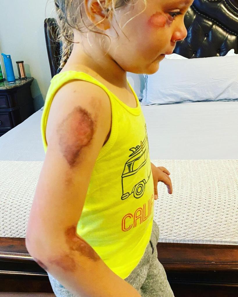 alfonso ribeiro's daughter ava with wounds all over her arm and face