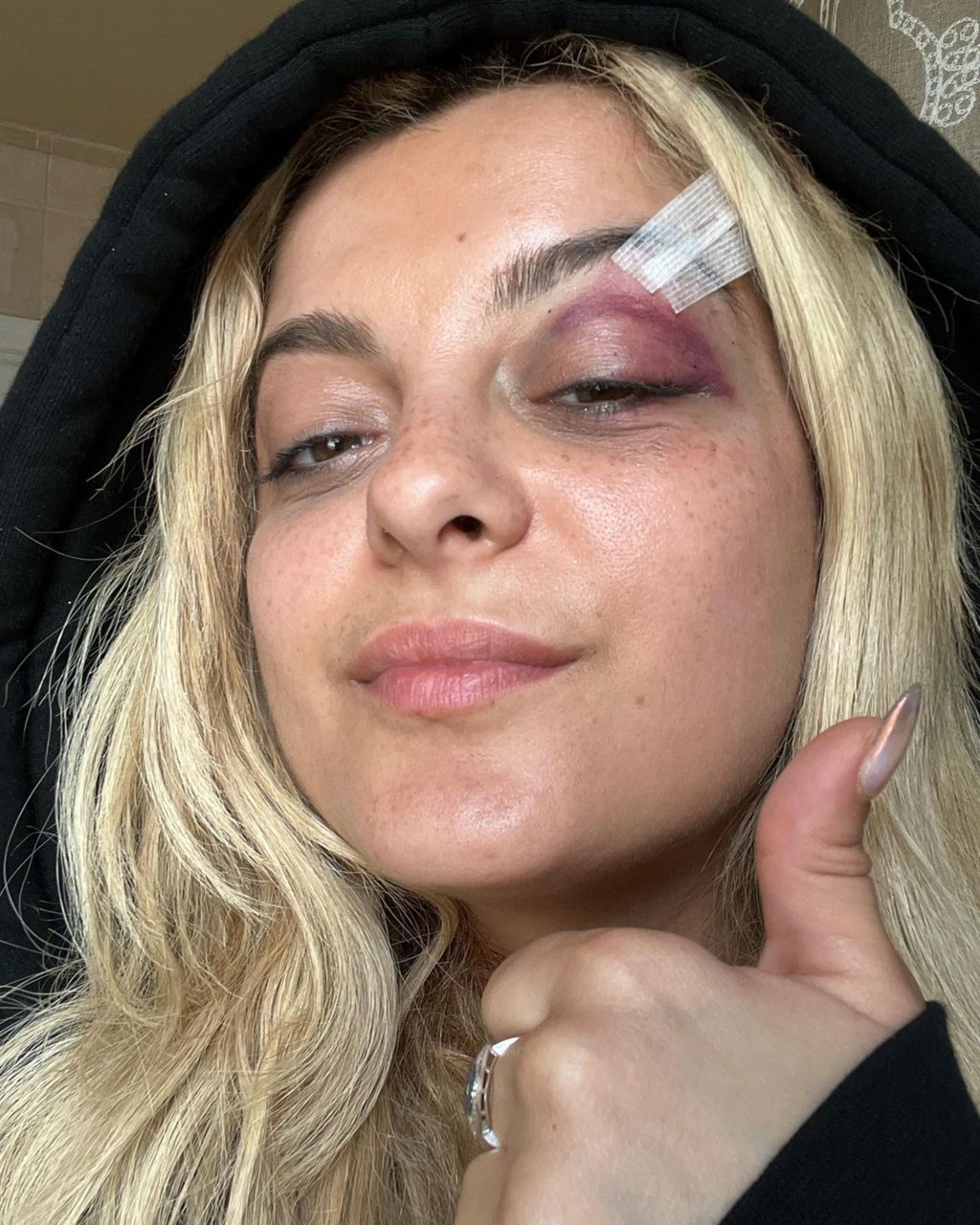 Bebe Rexha's black eye.