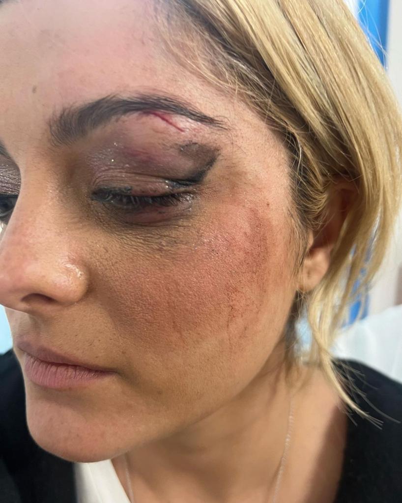 Bebe Rexha's black eye. 