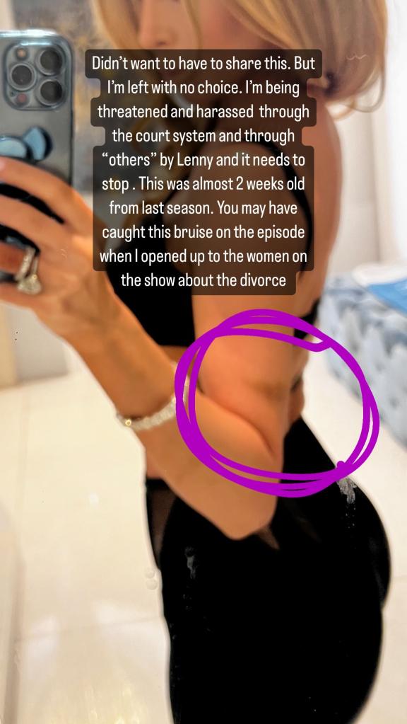 Lisa Hochstein's mirror selfie with a bruise on her arm.
