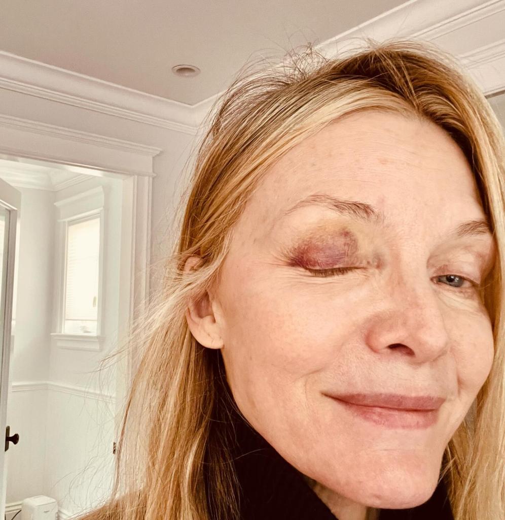 A selfie of Michelle Pfeiffer with a black eye.