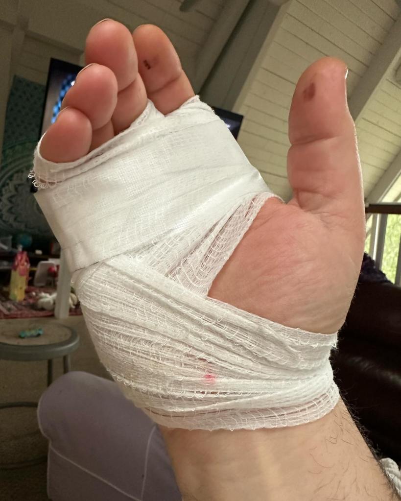 a heavily bandaged hand