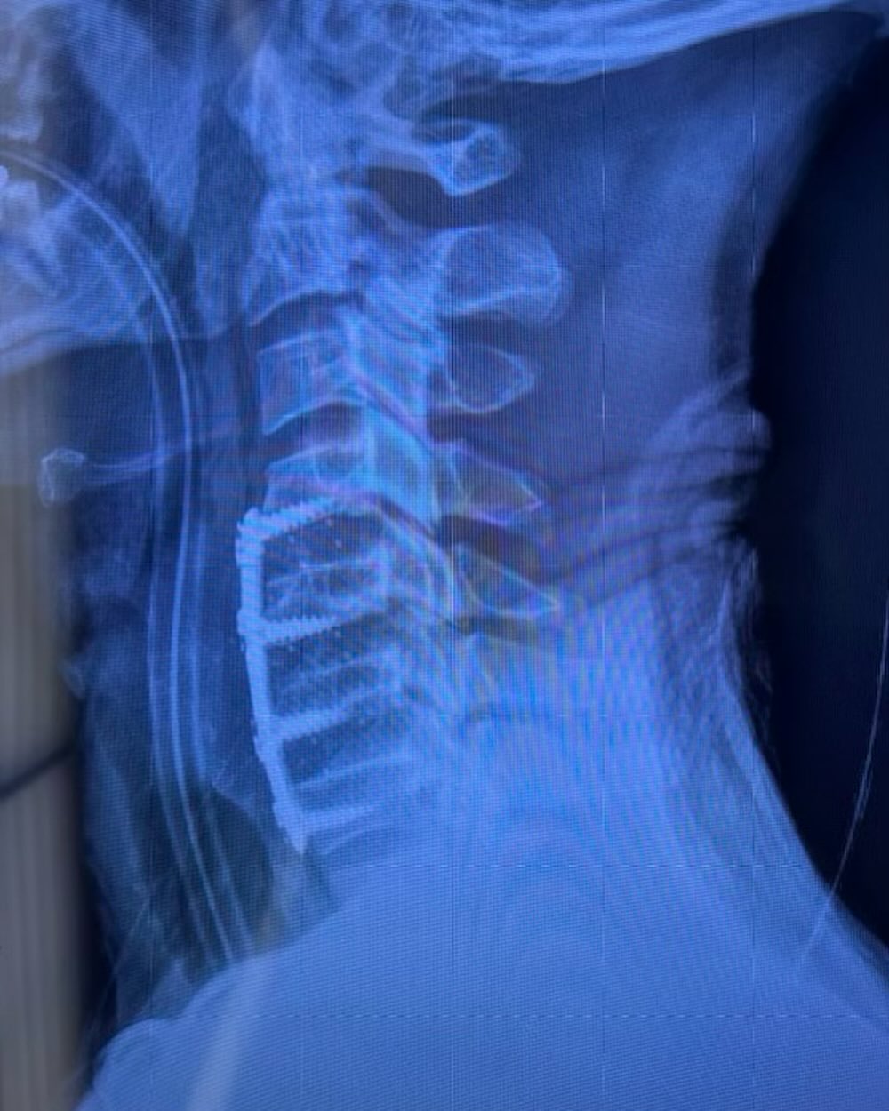 Val Chmerkovskiy's neck X-ray